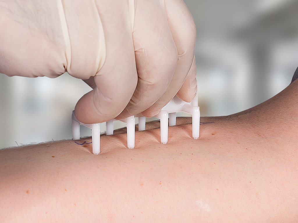 Paciente realizando Prick Test na (teste cutaneo) com Dr Logan Morais para diagnóstico de alergias respiratórias, alimentares e dermatológicas.